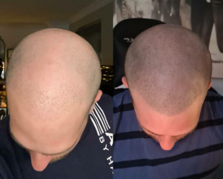 How To Identify and Prevent Infection After Scalp Micropigmentation Treatment